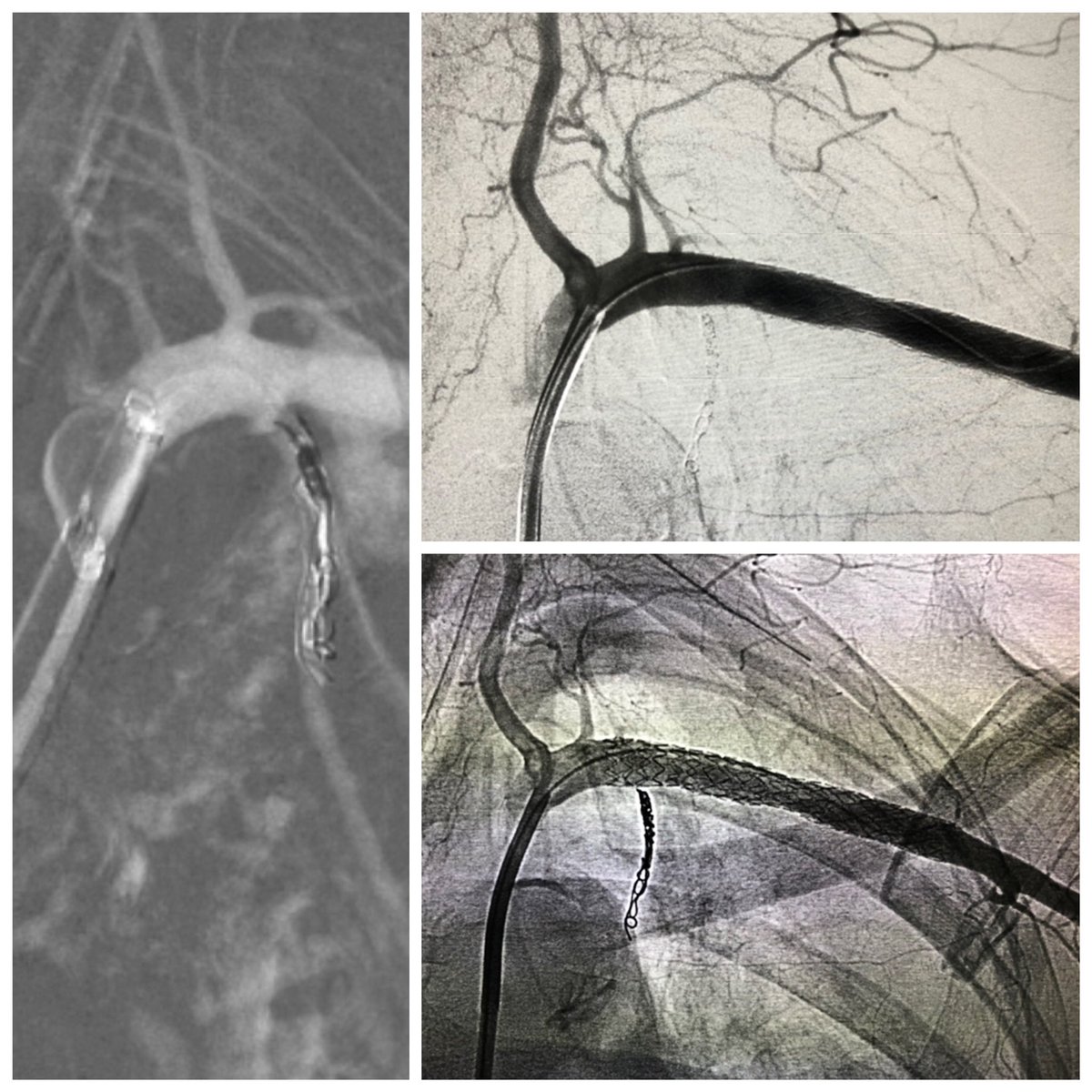 Guilherme S. Nakiri (@gnakiri) on Twitter photo Traumatic laceration of subclavian artery involving the origin of Internal Thoracic Artery. Use of balloon GC as a helpful tool to immediately stop massive bleeding, allowing precise ITA coiling with no rush, followed by covered stent deployment. <a href="/SIRspecialists/">Society of Interventional Radiology</a> @SOBRICEOFICIAL Traumatic laceration of subclavian artery involving the origin of Internal Thoracic Artery. Use of balloon GC as a helpful tool to immediately stop massive bleeding, allowing precise ITA coiling with no rush, followed by covered stent deployment. <a href="/SIRspecialists/">Society of Interventional Radiology</a> @SOBRICEOFICIAL