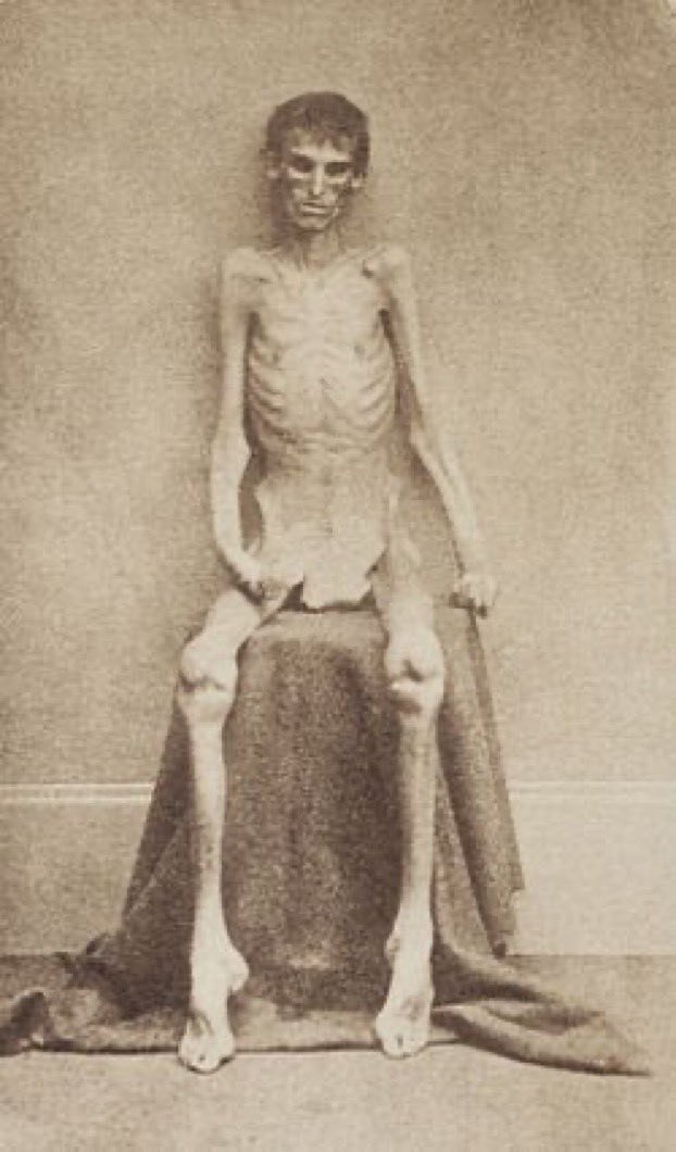 #5: Prison (Part 1)White Union solider after being freed from the confederate prison at Andersonville, Georgia. Many black and white Union prisoners died from neglect and harsh treatment during the Civil War.