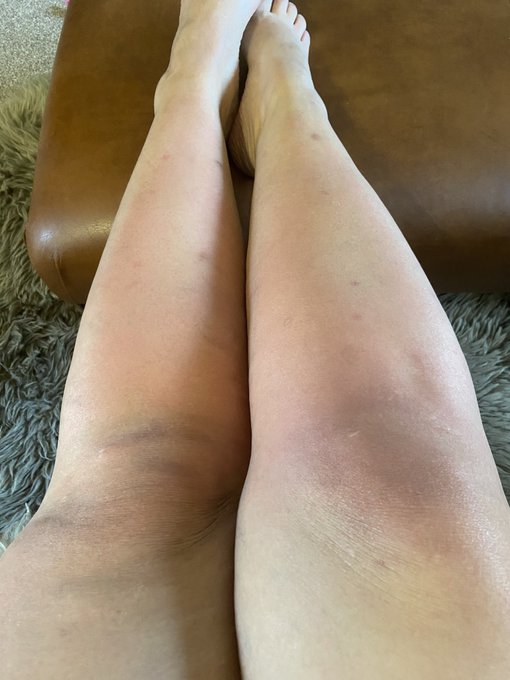 Sunburnt legs wasn&rsquo;t in the plan today!!! Oweeeee  feeling sorry for myself now! https://t.co/Zr1NMN<a href="/tag/adultwork"class="tags"><span>#adultwork</span></a><a href="/tag/directchat"class="tags"><span>#directchat</span></a>