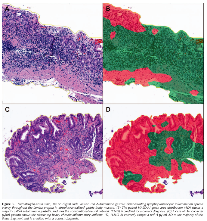 ArchivesPath's tweet photo. "A Deep Learning Convolutional Neural Network Can Differentiate Between Helicobacter Pylori Gastritis and Autoimmune Gastritis With Results Comparable to Gastrointestinal Pathologists" Franklin et al., #EarlyOnline #gipath #AIpath https://t.co/teiW9Fe0kg https://t.co/Kiukl8pBbW
