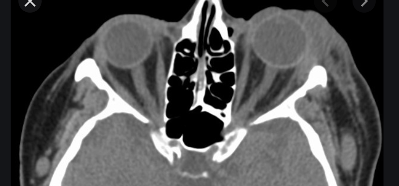 #idboardreview 30 M presents w/ 2days of eyelid swelling, pain, redness, diplopia, discharge &amp; restriction of eye movements. CT lacrimal gland swelling. dx? #medEd #idmedEd #idtwitter