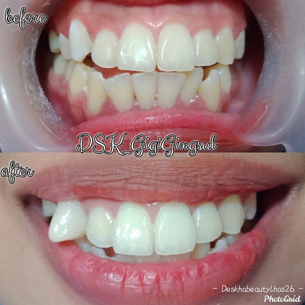 Ada yang tumpul ke atas-tajem ke bawah tapi bukan hukum di Indonesia.

Taring ereksi by: deskhabeautylhas21 | ig