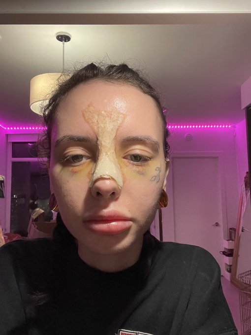 Update cast removal in 3 days https://t.co/vRUDusEIIN