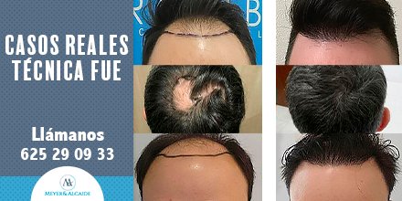 MeyeryAlcaide's tweet photo. ¡Adiós a la #Alopecia!😜

La #TécnicaFUE 👌 es una de nuestros métodos más avanzados y efectivos 🔝 para recuperar tu #Cabello

Estos son los fantásticos resultados 😍 de varios de nuestros #Pacientes tras someterse a esta #Cirugía

📩 Info@implantecapilarmalaga.com 📩 https://t.co/s0tm9PVPz3