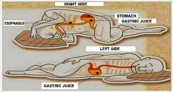 #TIPS
Posisi tidur penderita refluks asam lambung (GERD) yg dianjurkan tuh miring kiri krn gravitasi membuat isi lambung nggak nyampe ke sfingter/katup sehingga menurunkan risiko refluks.
Selalu ingat, jangan rebahan/tiduran setelah makan. Jaraki 2-4 jam.