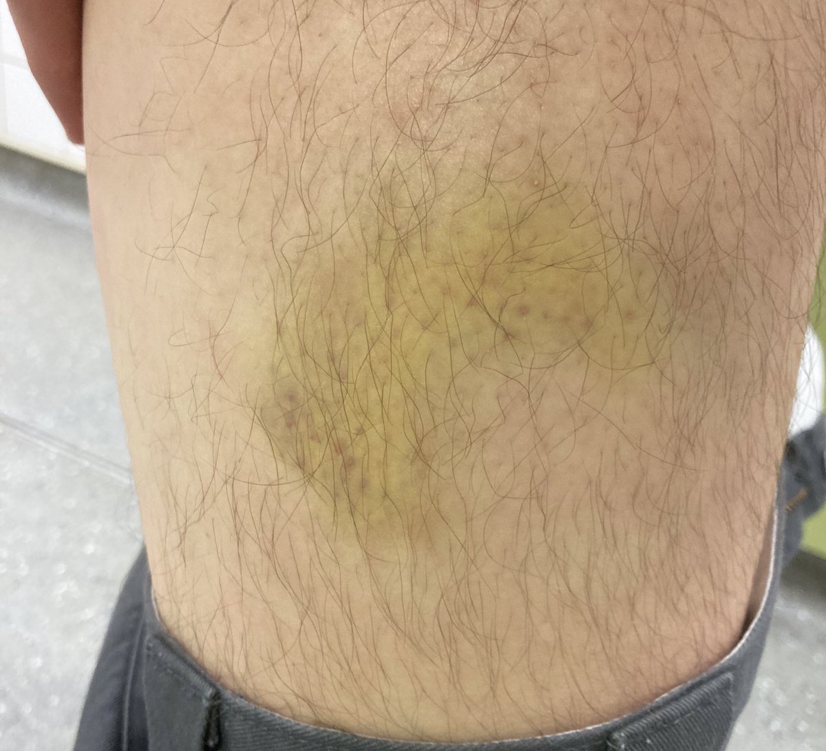 Pretty huge bruise that’s come through on the leg of the student assaulted by security on Thursday evening