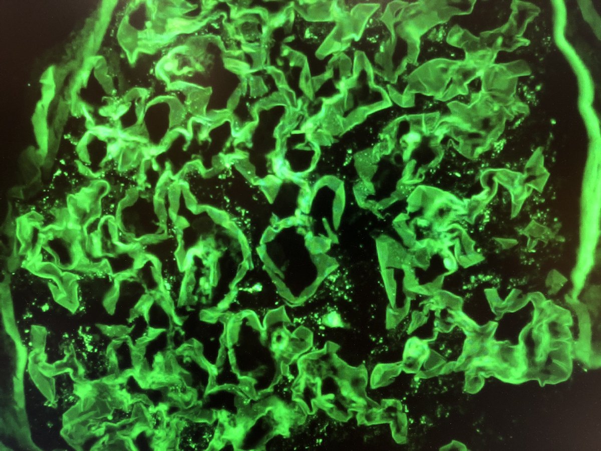 Evidence of anti-nephrin in a podocytopathy with early segmental sclerosis (Caucasian patient). Don’t tell me that MCD/FSGS are not on the same spectrum. Let’s move away from pure morphologic classifications and get to the bottom of progression factors in this autoimmune disease.
