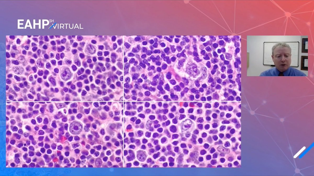 SocforHemepath's tweet photo. #EAHPSH2021 Dr. Cook @jrcookMDPhD from Cleveland Clinic presents a case of follicular T-cell lymphoma with Hodgkin-like cells and alternate diagnostic considerations of classic Hodgkin lymphoma, NLPHL, and angioimmunoblastic T-cell lymphoma. #hemepath https://t.co/ARyjyv8c1u