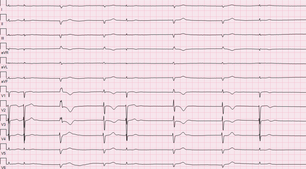 thoughts on EKG. pt with h/o of cryomaze, CABG (SVG-RCA)+TV repair. #EPeeps fellows first <a href="/narrowQRS/">JMC</a>  <a href="/SchakrabartiEP/">Shanta Chakrabarti</a>