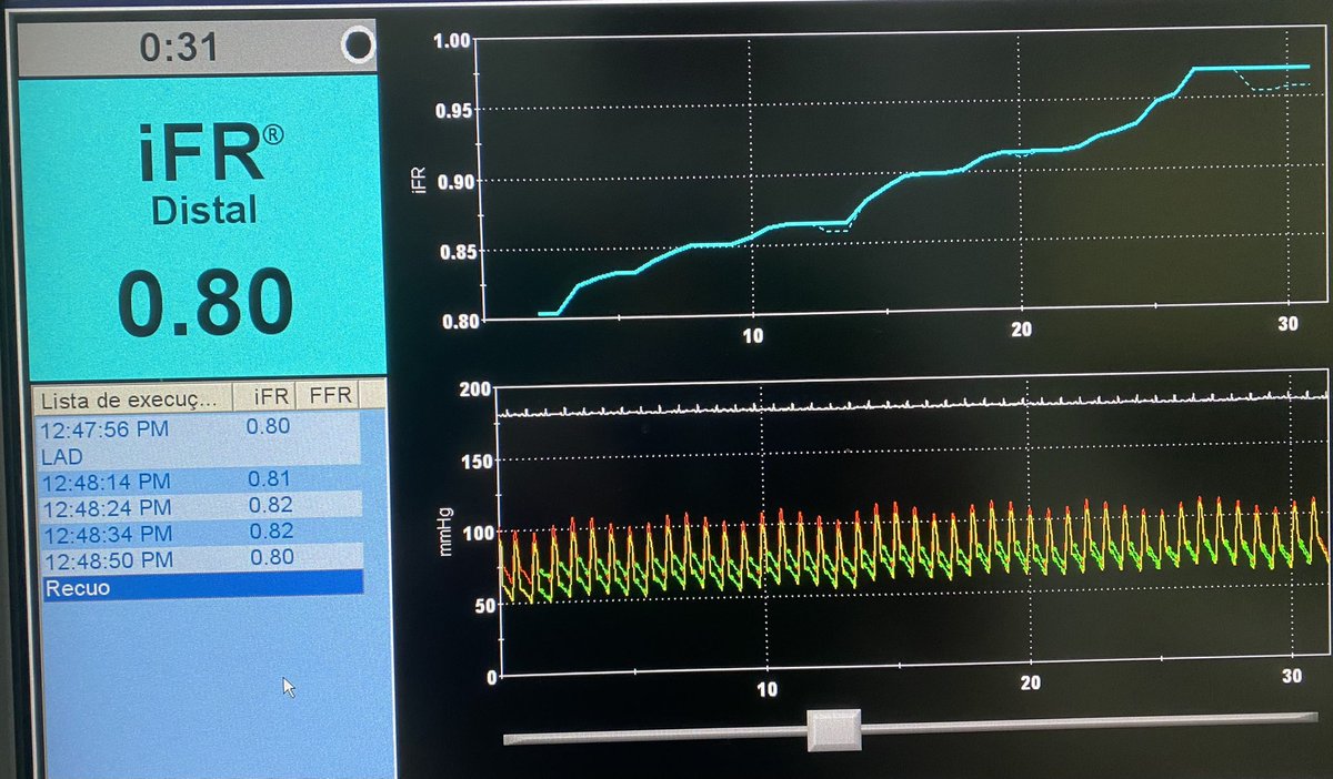 evandrofilhobr's tweet image. #ICFIT - iFR LAD pullback showing “ramp” pattern. 

Stable CAD &amp;amp; Diffusely disease LAD in a young diabetic patient.

OMT all the way for this one!