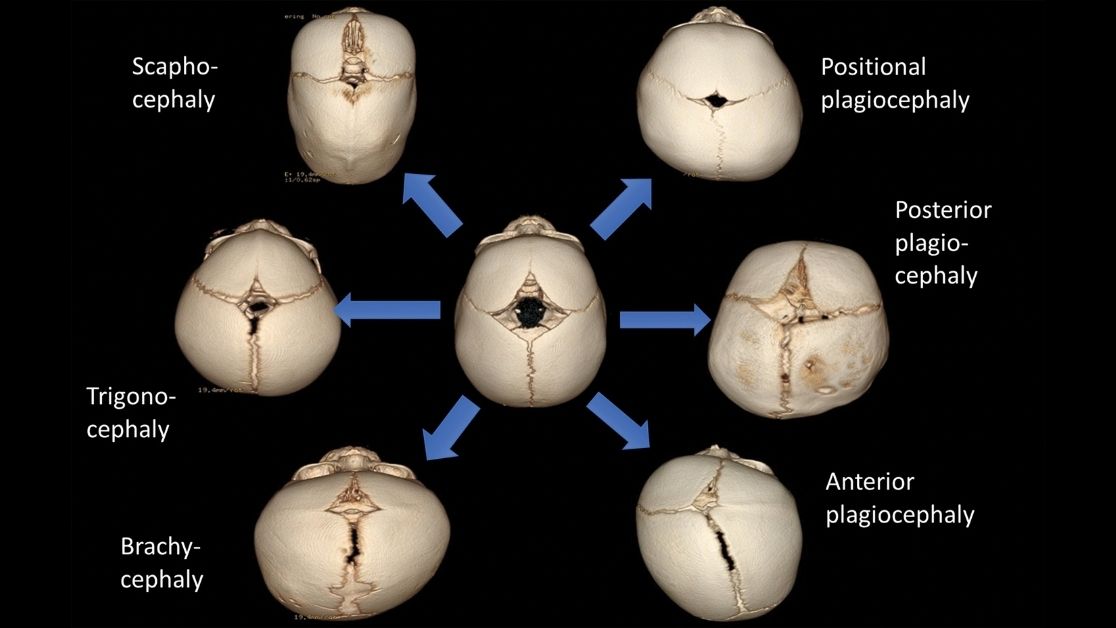 In Children With Suspected Craniosynostosis Low Dose Ct Is The Imaging Modality Of Choice Familiarize Yourself With The Relevant Anatomy Syndromic Causes And Ct Findings In The Main Craniosynostoses Bit Ly 3rjaqvl Pedsrad Radrespic