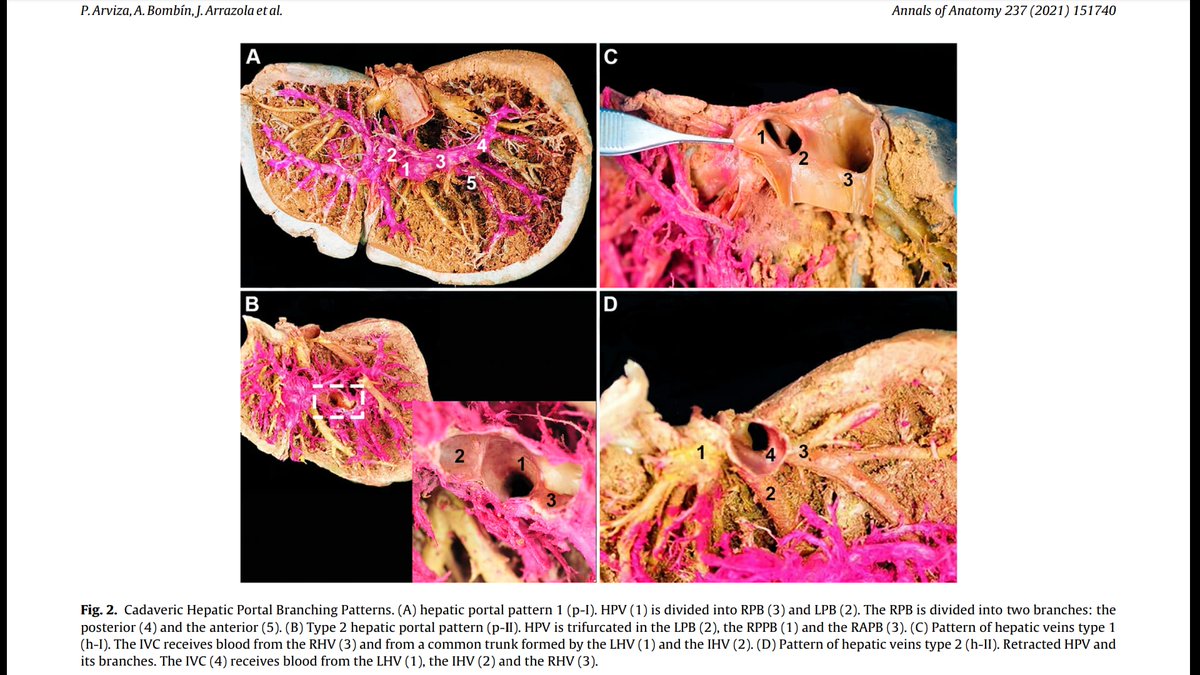 It's always great to see the payoff for work done.

sciencedirect.com/science/articl…

<a href="/AsierBombin/">Asier Bombín</a> <a href="/jrsanudo/">Jose Sañudo</a> <a href="/PasionAnatomia/">Pasión por la Anatomía</a> <a href="/AnatomiaUnam/">Anatomia FacMed</a> <a href="/MedClubPage/">MedClub</a> <a href="/researchactive/">Richard Brady (researchactive.bsky.social)</a> <a href="/SETHepatico/">SETH</a> #SoMe4Surgery