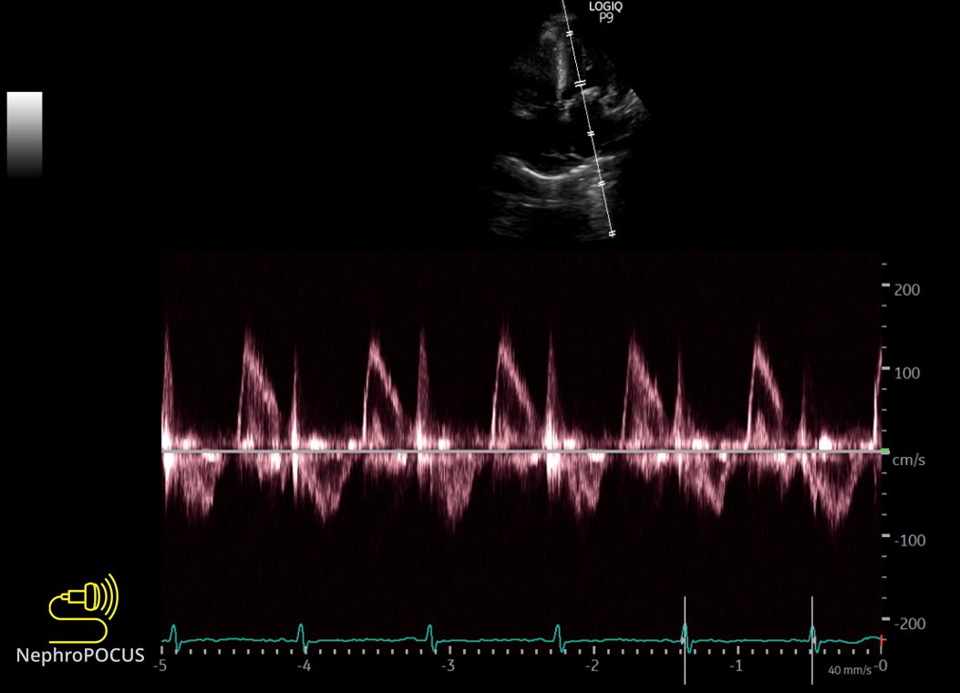 Mitral inflow Doppler  #echofirst to assess echocardiographic pulsus paradoxus Obtained during quiet breathing; no sniff