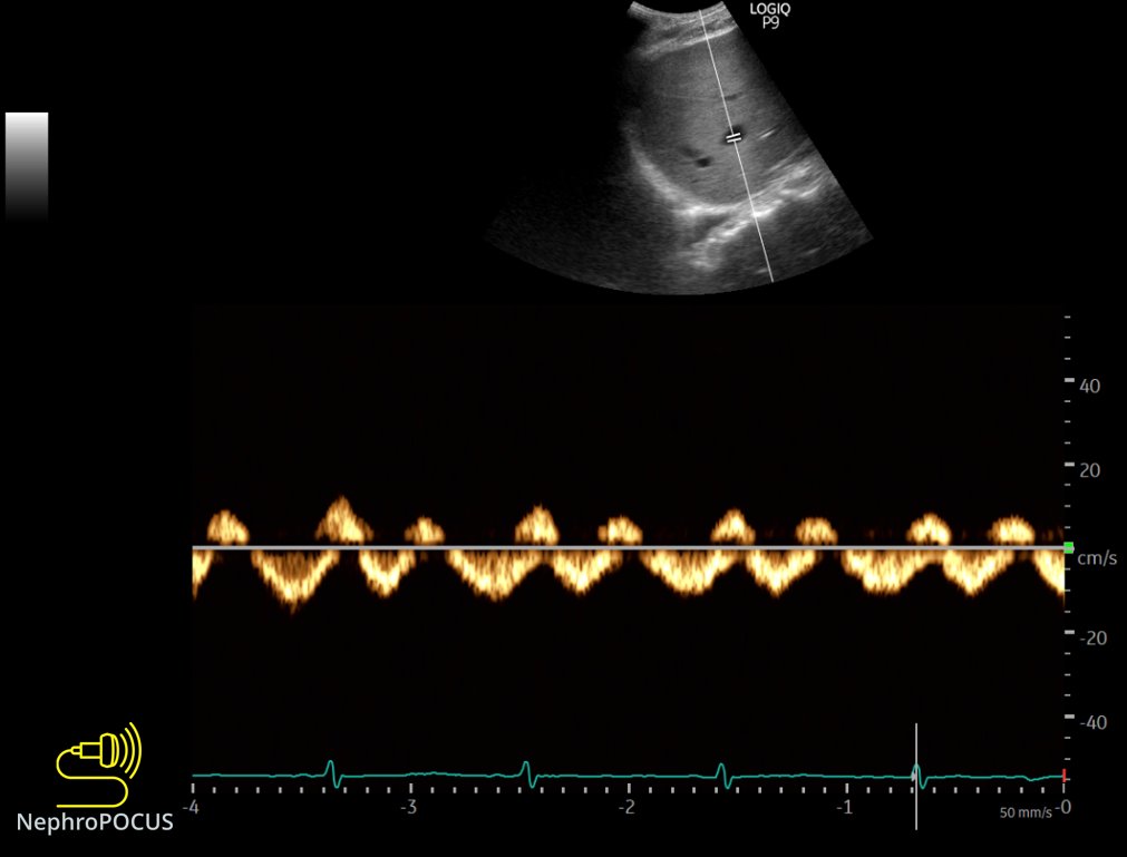 Images for  #VExUS  #POCUS enthusiastsHepatic vein Looks almost normalThis is a kind of tracing where S and D can be confused for one another without EKG