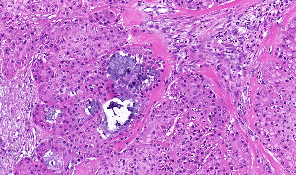 Parotid, adult

#ENTpath #OralPath #Pathtwitter