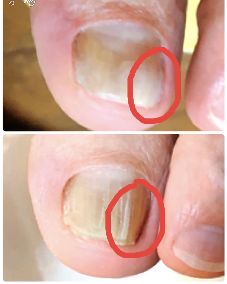 Nailcare 最強ケアリスト Nailcarec Twitter