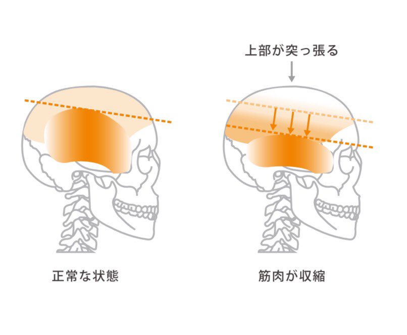 ヒロキ 頭皮揉みます と多数の声をいただきましたが 筋肉の位置を正しく理解して揉む必要があります よく 頭皮が硬い と言いますが 頭頂部に筋肉は無く あるのは 膜 だけ 筋肉は凝ると収縮し テッペンの膜は引き伸ばされ硬くなり血行不良に
