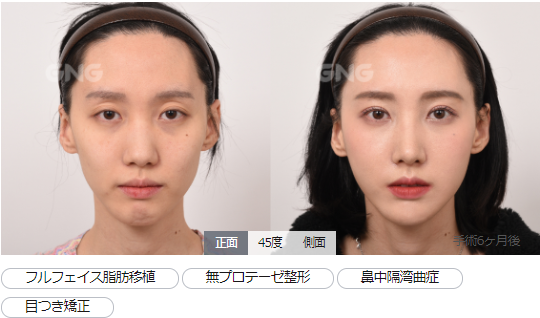 目つき矯正 目つき矯正