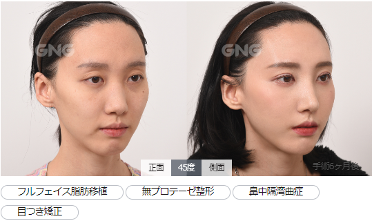 目つき矯正 目つき矯正