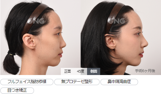 目つき矯正 目つき矯正