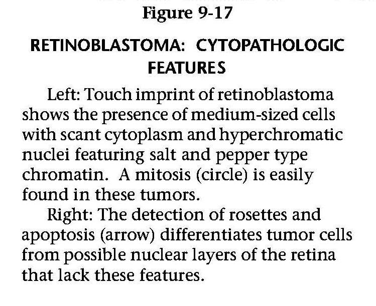 ARP Press (@arp_press) on Twitter photo Featured Images Set #5: Tumors of the Eye and Ocular Adnexa by Dr. Folberg <a href="/EyePath/">Robert Folberg</a> @patychevez1 <a href="/StudyPathology/">Amy Lin, MD</a> & <a href="/MilmanTatyana/">Tatyana Milman</a>.
Retinoblastoma: cytopathologic features (figure 9-17).
Order book at arppress.org.
#eyetumor #eyepath #pathology #tumor #pathresidents Featured Images Set #5: Tumors of the Eye and Ocular Adnexa by Dr. Folberg <a href="/EyePath/">Robert Folberg</a> @patychevez1 <a href="/StudyPathology/">Amy Lin, MD</a> & <a href="/MilmanTatyana/">Tatyana Milman</a>.
Retinoblastoma: cytopathologic features (figure 9-17).
Order book at arppress.org.
#eyetumor #eyepath #pathology #tumor #pathresidents
