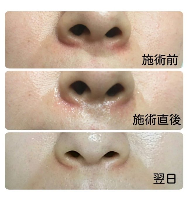 小鼻のtwitterイラスト検索結果