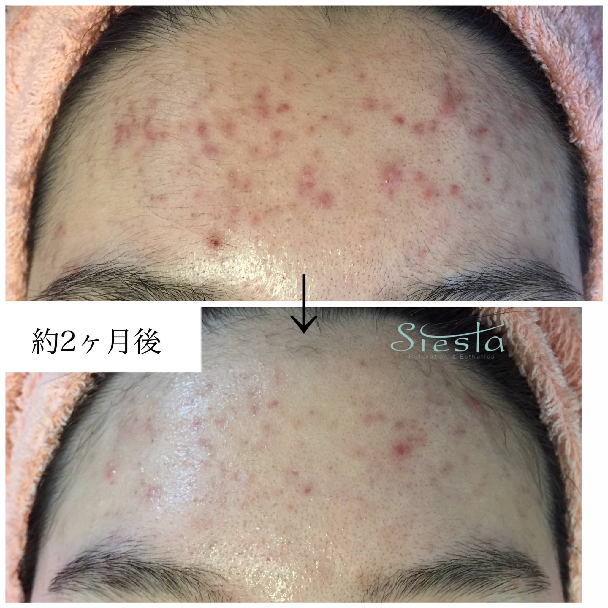 大阪 堺深井 ニキビケア 体質別ケアエステ シエスタ 刀禰麻美 おでこのニキビ跡も どんどん引いてきてる メールでは もっと薄くなってきたとのこと 嬉しくて泣きそう ニキビあと 肌荒れ改善 T Co Hnozqicbl3 Twitter 大阪 堺深井 ニキビケア 体質別ケアエステ シエスタ 刀禰麻美 おでこのニキビ跡も どんどん引いてきてる メールでは もっと薄くなってきたとのこと 嬉しくて泣きそう ニキビあと 肌荒れ改善 T Co Hnozqicbl3 Twitter