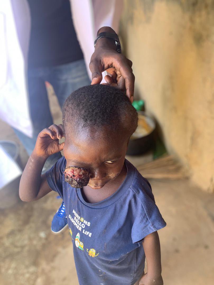 BHUMSA_'s tweet photo. APPEAL FOR SUPPORT!

The 600L medical students of Bingham University, during their community diagnosis in Kagoro, Kaduna state, met a family with a 5 year old suffering from retinoblastoma as shown in the pictures, and are soliciting for funds to aid in his treatment. https://t.co/SNxLjmBvJJ