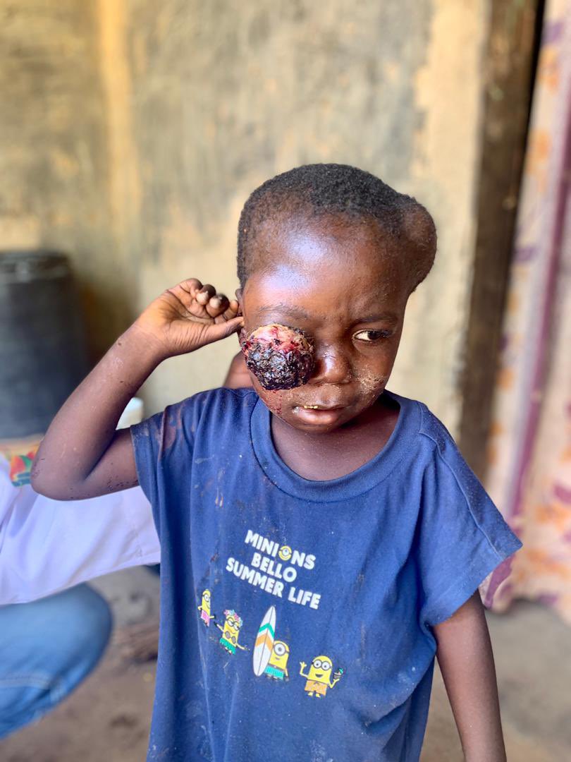BHUMSA_'s tweet photo. APPEAL FOR SUPPORT!

The 600L medical students of Bingham University, during their community diagnosis in Kagoro, Kaduna state, met a family with a 5 year old suffering from retinoblastoma as shown in the pictures, and are soliciting for funds to aid in his treatment. https://t.co/SNxLjmBvJJ