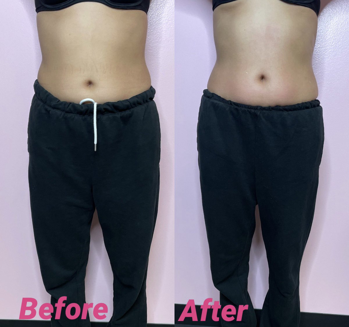 BarbieEsthetics's tweet photo. Real life results 🔥
1 Session. https://t.co/2L2Ip9uLBf