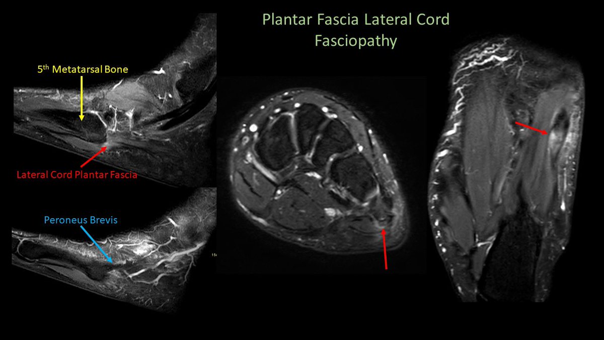 Angel Gómez-Cintrón, MD, MPH (@skeletalrad) on Twitter photo Plantar Lateral Cord Fasciopathy!
You surely know about plantar fasciitis. But do you know that the distal insertion of the plantar fascia lateral cord can also get inflamed? It inserts at the plantar aspect of the 5th metatarsal base, adjacent to the peroneus brevis insertion. Plantar Lateral Cord Fasciopathy!
You surely know about plantar fasciitis. But do you know that the distal insertion of the plantar fascia lateral cord can also get inflamed? It inserts at the plantar aspect of the 5th metatarsal base, adjacent to the peroneus brevis insertion.