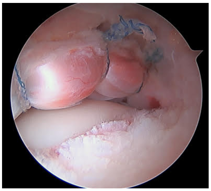 In patients age &gt;40, acetabular labral repair &amp; postop physical therapy leads to better outcomes than physical therapy alone. #EducateThePatient ow.ly/fWPt50EnCkT
