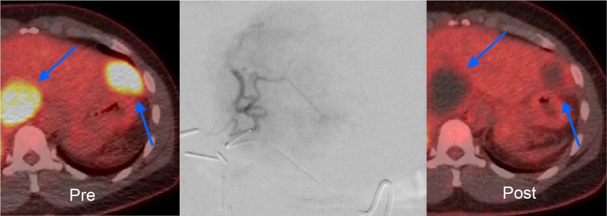 Rahul Sheth (@rahulshethmd) on Twitter photo I love to see "black holes" on follow up imaging. Nice outcome for ~5cm adrenal cancer mets to the liver x 2 using <a href="/TriSalusLifeSci/">TriSalus Life Sciences</a> pressure-enabled drug delivery catheter <a href="/SIRspecialists/">Society of Interventional Radiology</a> <a href="/SIRRFS/">SIR RFS</a> <a href="/SIR_ECS/">SIR ECS</a> <a href="/SIO_Central/">SIO</a> #irad <a href="/HCIRad/">Houston Combined IR Residency</a> <a href="/jdkubanMD/">Josh Kuban</a> <a href="/ajgunnmd/">AJ Gunn</a> I love to see "black holes" on follow up imaging. Nice outcome for ~5cm adrenal cancer mets to the liver x 2 using <a href="/TriSalusLifeSci/">TriSalus Life Sciences</a> pressure-enabled drug delivery catheter <a href="/SIRspecialists/">Society of Interventional Radiology</a> <a href="/SIRRFS/">SIR RFS</a> <a href="/SIR_ECS/">SIR ECS</a> <a href="/SIO_Central/">SIO</a> #irad <a href="/HCIRad/">Houston Combined IR Residency</a> <a href="/jdkubanMD/">Josh Kuban</a> <a href="/ajgunnmd/">AJ Gunn</a>
