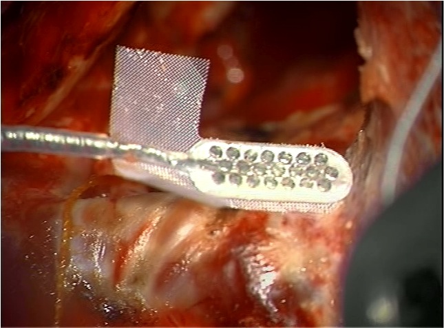 SBase360's tweet photo. The auditory brainstem implant directly stimulates the cochlear nucleus of the brainstem bypassing the cochlea & VIIIth nerve. For many patients with NF2 and rarely some other forms of deafness the ABI remains the only way to restore hearing. #Auditorybrainstem #houseinstitute https://t.co/WJ6xcjtp6o