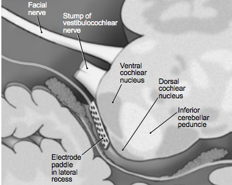 SBase360's tweet photo. The auditory brainstem implant directly stimulates the cochlear nucleus of the brainstem bypassing the cochlea & VIIIth nerve. For many patients with NF2 and rarely some other forms of deafness the ABI remains the only way to restore hearing. #Auditorybrainstem #houseinstitute https://t.co/WJ6xcjtp6o