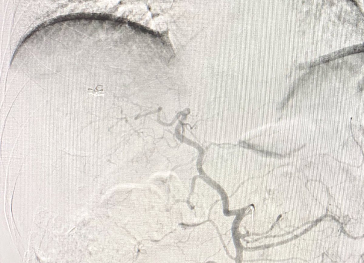 #Radres #IRadres thoughts?