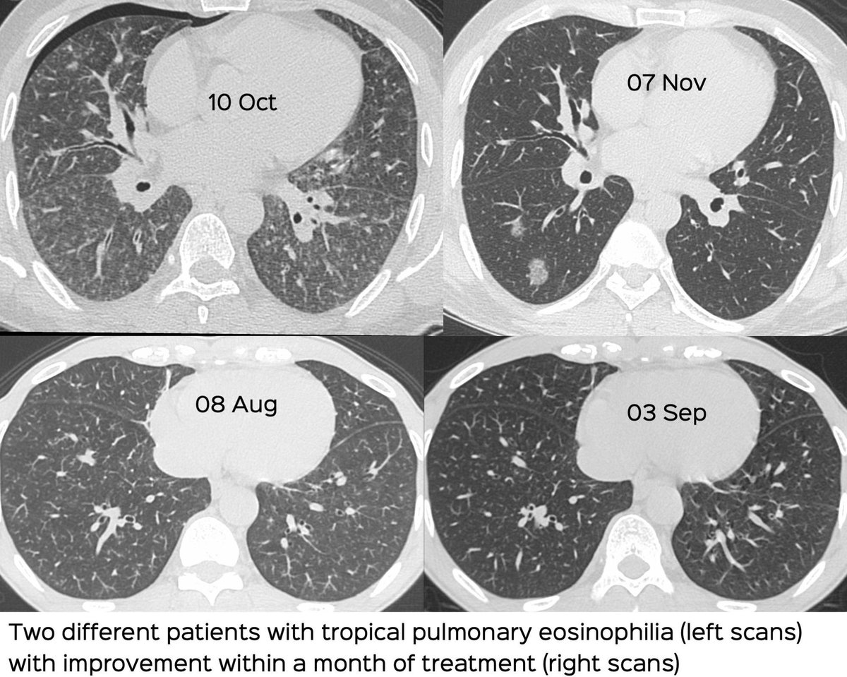 How does one suspect and diagnose tropical pulmonary eosinophilia?
ctchestreview.com/tpe01/
The post and video explain with cases and D/Ds.
#ctchest #tropicalpulmonaryeosinophilia #radres #lungtwitter #lungrad #ild