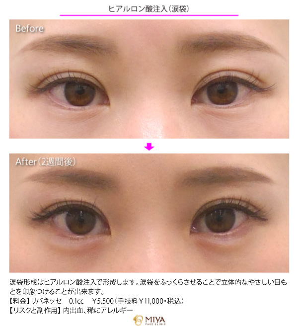 Miyaフェイスクリニック マスク美人は目元から ヒアルロン酸で涙袋形成で華やか 表情豊かな目元に マスクをする事の多いこの時期に 目元まわりを華やかにすることで美人力をアップさせちゃいましょう 既存の患者様限定10 Offも開催中です
