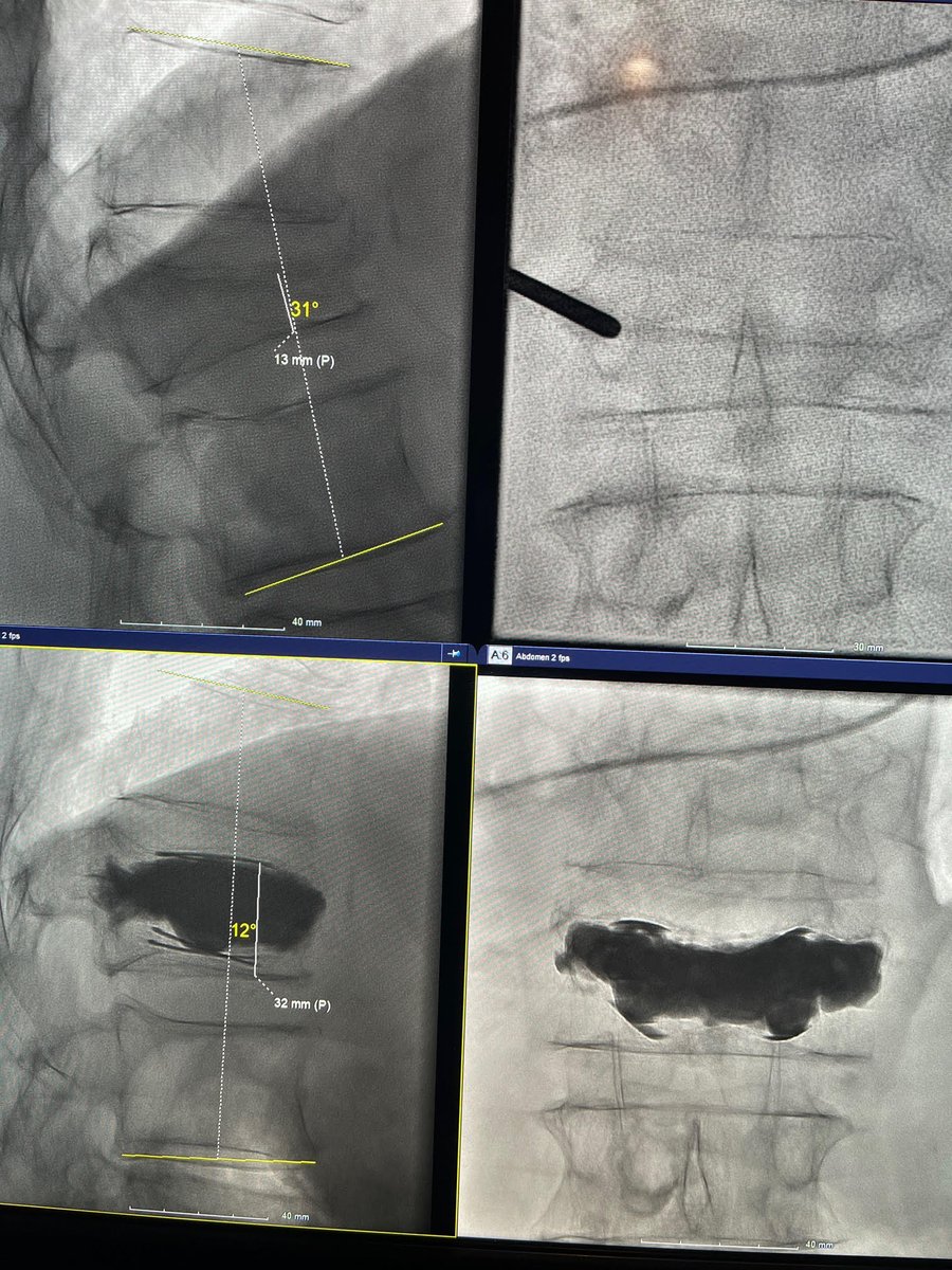 Arun Jagannathan (@dr_ajag) on Twitter photo First time I had to open a second kit for a single level. 18cc...filled it like the Boss <a href="/dougbeall/">Douglas Beall</a> preaches! ๐#restorethesagi #spinejack #irad @TheStrykerIVS <a href="/SIRspecialists/">Society of Interventional Radiology</a> <a href="/_backtable/">BackTable Vascular and Interventional</a> First time I had to open a second kit for a single level. 18cc...filled it like the Boss <a href="/dougbeall/">Douglas Beall</a> preaches! ๐#restorethesagi #spinejack #irad @TheStrykerIVS <a href="/SIRspecialists/">Society of Interventional Radiology</a> <a href="/_backtable/">BackTable Vascular and Interventional</a>