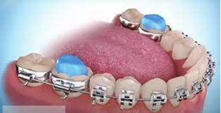 thetooth_dr's tweet photo. If your orthodontist has given you bite blocks, it’s because the way your teeth come into contact with each other could damage them or slow down the straightening of your teeth by braces

#flossdental #thetoothdr #dentalbraces #biteblock #healthline #cookeortho #trinidadandtobago https://t.co/3ja6JezfjN