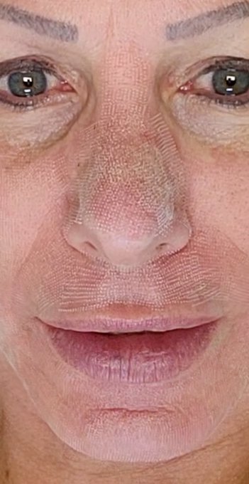 CO2 fractional laser treatment, day one 🥵 I'll be out for about 2 weeks ya'll 😷 https://t.co/Yo5AZ2b<a href="/tag/amazon"class="tags"><span>#amazon</span></a><a href="/tag/twitter"class="tags"><span>#twitter</span></a><a href="/tag/ripoff"class="tags"><span>#ripoff</span></a><a href="/tag/theif"class="tags"><span>#theif</span></a><a href="/tag/fakereviews"class="tags"><span>#fakereviews</span></a>
