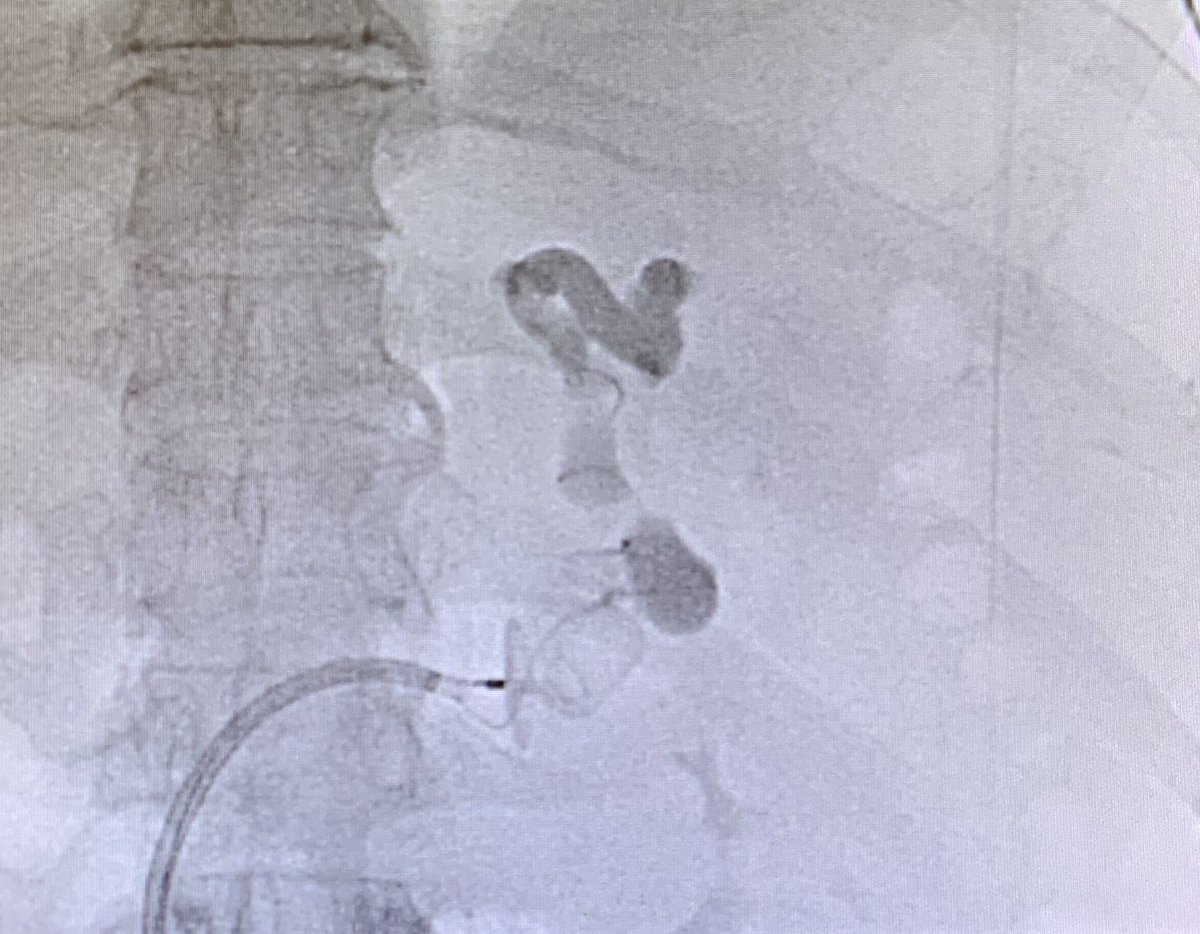 Patient w/ uncontrolled encephalopathy refractory to medication. Large splenorenal shunt seen on CT, with subsequent PARTO. Decrease in shunting away from the liver (aka improved hepatopetal flow) allows for improved ammonia breakdown and improved mentation. #IRad