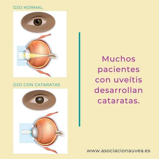 uveitis_auvea's tweet photo. Muchos pacientes con #uveítis desarrollan #cataratas, por la enfermedad en sí o el uso de medicamentos como corticoides.
En el ojo hay una lente transparente (#cristalino) por el que pasan los rayos de luz y forman las imágenes. Cuando esta comienza a ser #opaca, hay cataratas. https://t.co/q5E0h85Rmq
