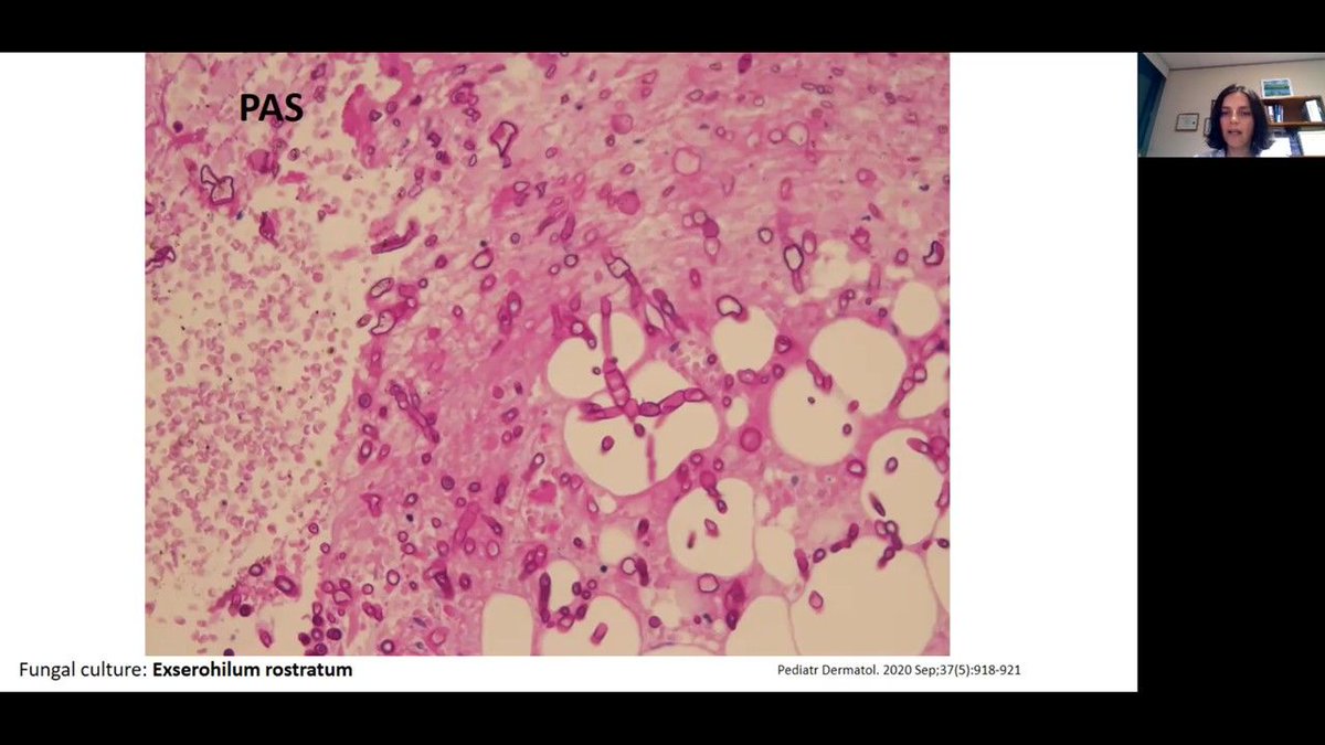 Infectious diseases session: The Good, The Bad, The Ugly Dr. Ana Ciurea - Phaeohyphomycosis #ISDP2021 #dermpath