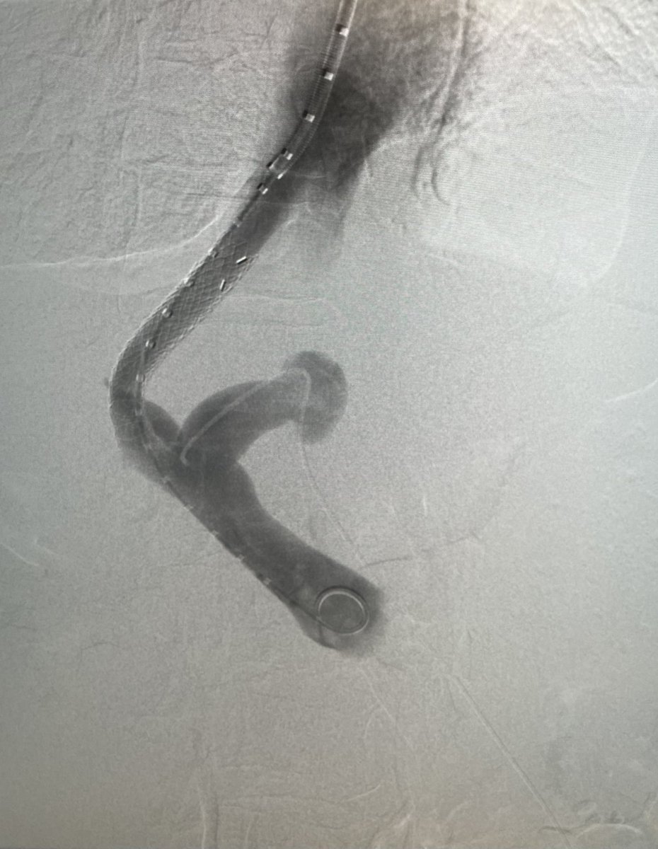 You can safely access a paraumbilical vein and do portography to localize your portal vein target for TIPS creation <a href="/UKY_IR/">UK IR</a> <a href="/UK_HealthCare/">UK HealthCare</a> <a href="/SIRspecialists/">Society of Interventional Radiology</a> <a href="/SIRRFS/">SIR RFS</a> <a href="/UKy_RAD_RES/">University of Kentucky Radiology Residency</a>