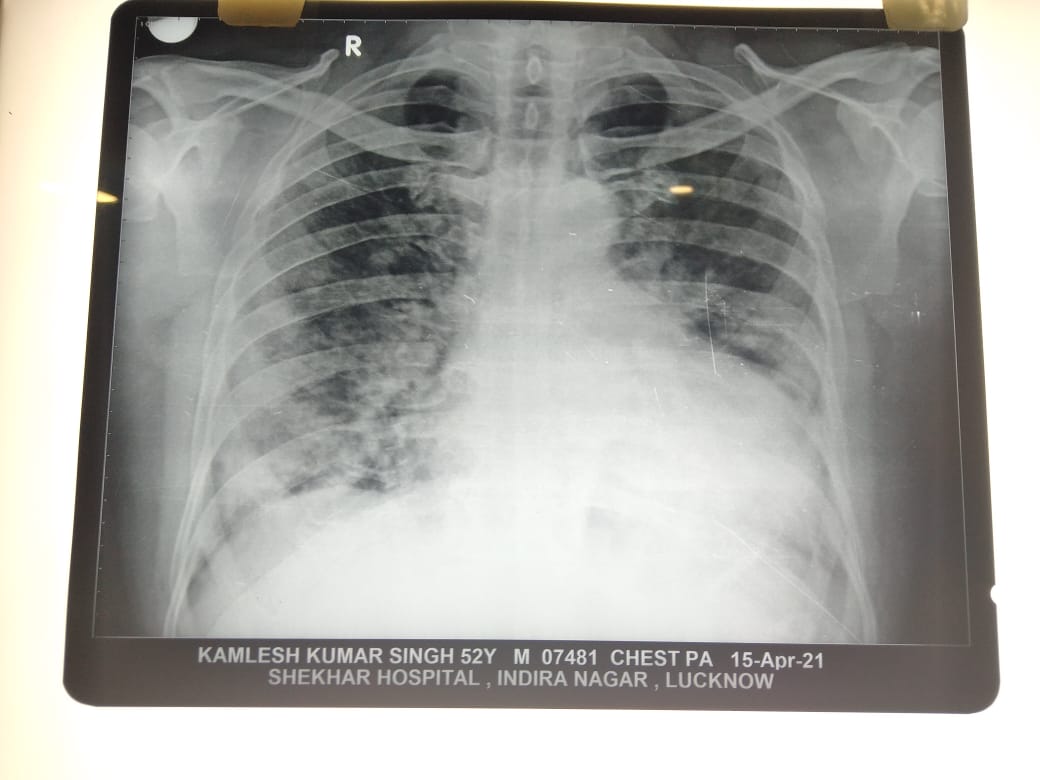 RahulSi68648714's tweet photo. @shalabhmani 
@anshusamskrit 
This report is of Kamlesh Kumar Singh
We are in Shekhar and need shift to covid hospital for proper treatment Still waiting for RT PCR report and its getting late and condition getting more critical. His oxygen level 86 after oxygen full.
#Helpplease https://t.co/WVi8BvBLaG