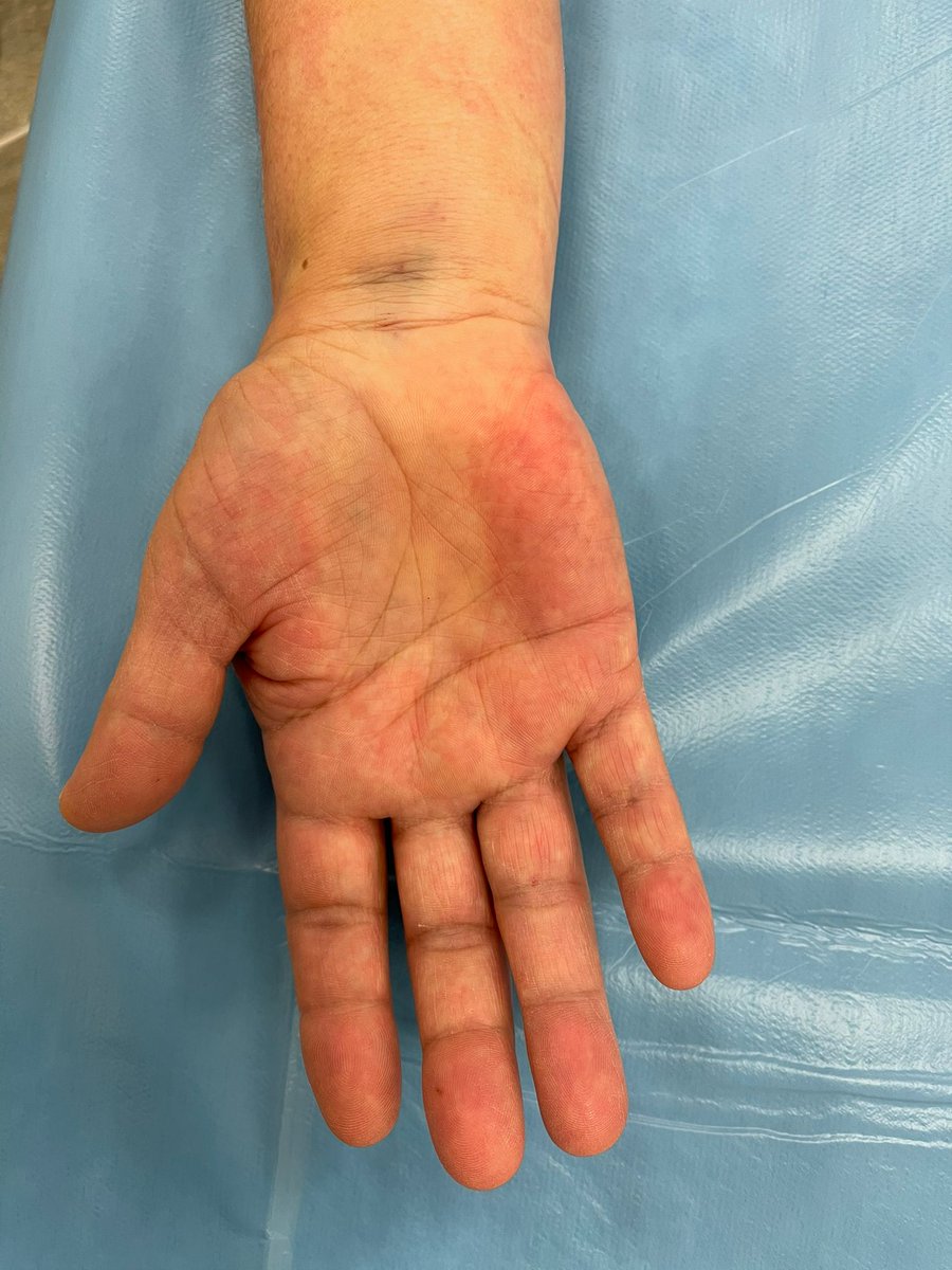 Aquesta setmana a la Unitat d'Extremitat Superior de COT de l'Hospital d'Igualada hem començat a operar amb la tècnica WALANT (Wide Awake Local Anesthesia No Tourniquet).
Optimitzant recursos, millorant la qualitat quirúrgica i amb pacients molt satisfets! 💪