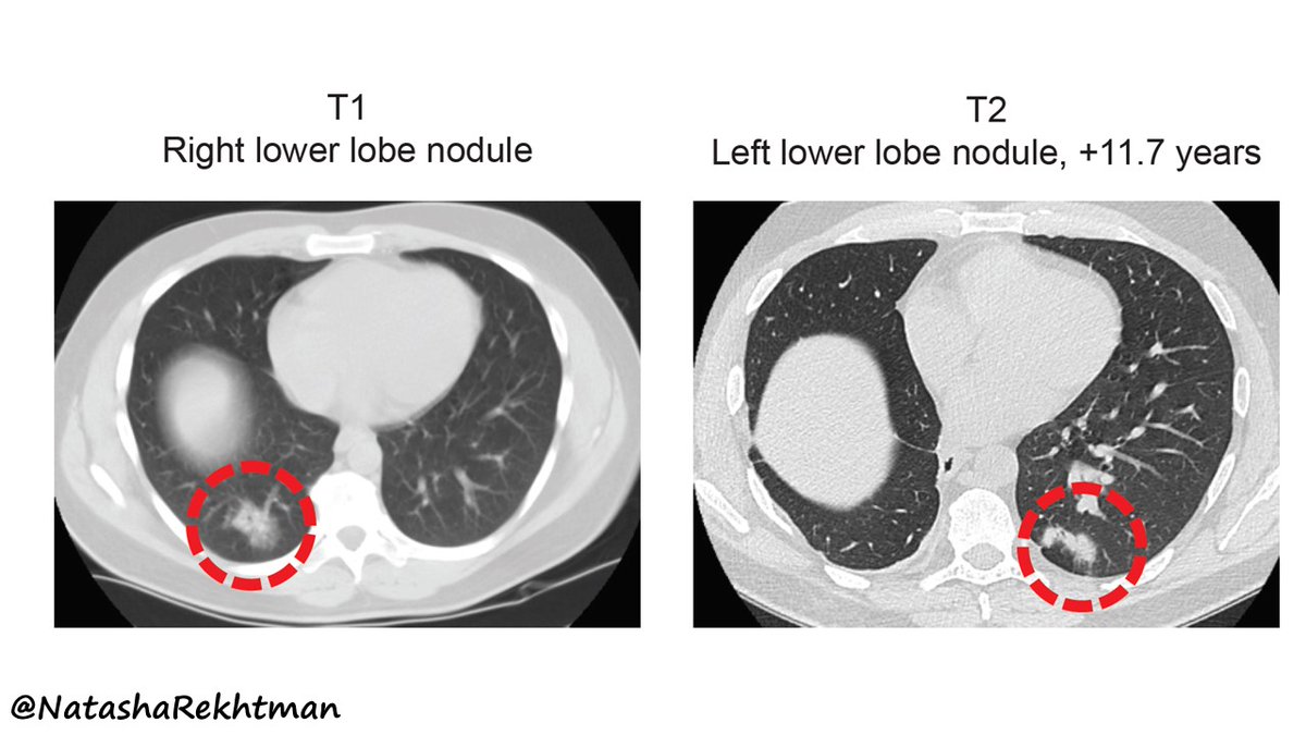 1/ Excited to share the latest #PulmPath study from our group. Let me introduce it with a case. 

This patient had a complete resection of lung adenocarcinoma. 11+ yrs later, he has a new contralateral tumor. No nodal or distant metastases.