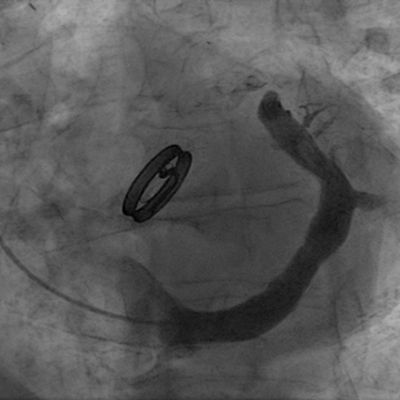 MyJSCAI (@myjscai) on Twitter photo Coronary Sinus Reducer to Improve Angina:
-n=15
-greater ischemia improvement with smaller CS sizes
-suggests mechanism of Reducer non-responsiveness in 15-30% of pts
onlinelibrary.wiley.com/doi/full/10.10…
Follow @CCIJournal, facebook.com/CCIJournal
Official Journal of <a href="/SCAI/">SCAI</a> Coronary Sinus Reducer to Improve Angina:
-n=15
-greater ischemia improvement with smaller CS sizes
-suggests mechanism of Reducer non-responsiveness in 15-30% of pts
onlinelibrary.wiley.com/doi/full/10.10…
Follow @CCIJournal, facebook.com/CCIJournal
Official Journal of <a href="/SCAI/">SCAI</a>