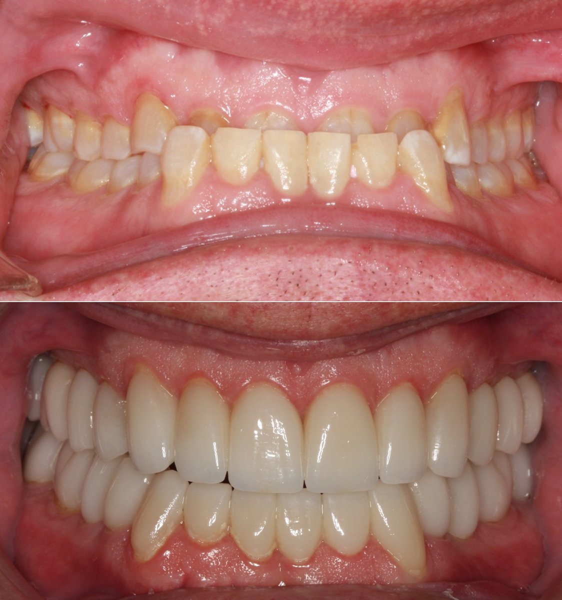 AmarilloSmiles's tweet photo. Life changing cosmetic reconstructive dentistry is what we are all about! Full mouth reconstruction and smile rejuvenation are Dr. Miller’s passion. https://t.co/3mVjC5HKja